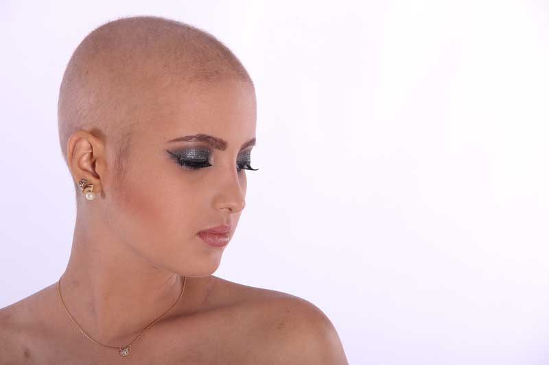 androgena alopecija kod žena