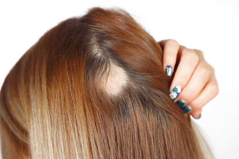 opadanje kose u pečatima kod žena