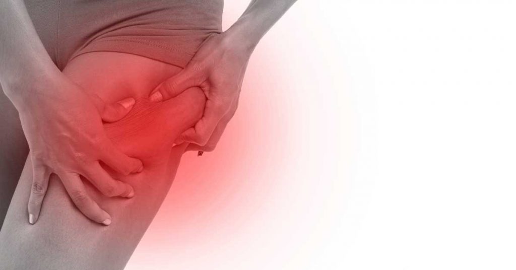 fibrozni celulit