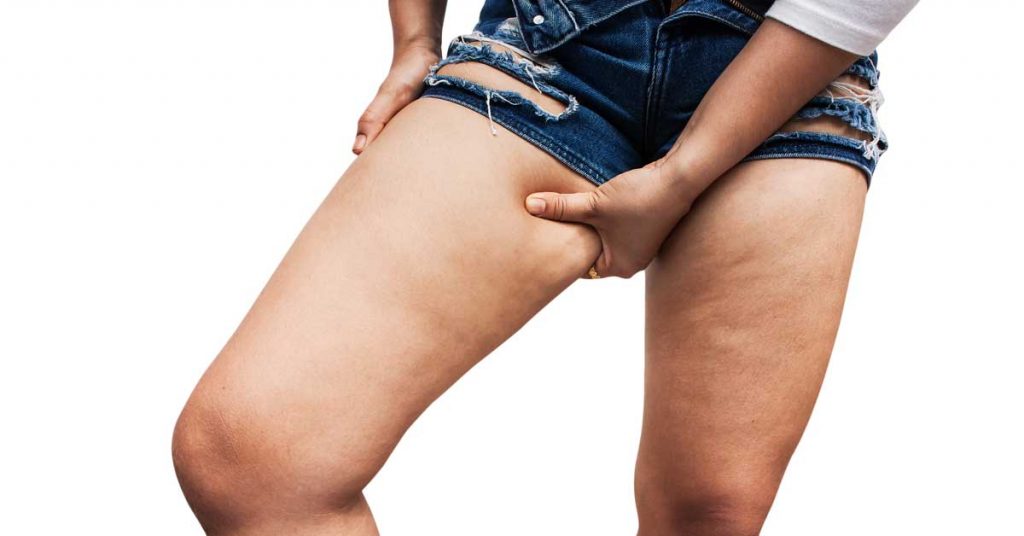 vodeni celulit