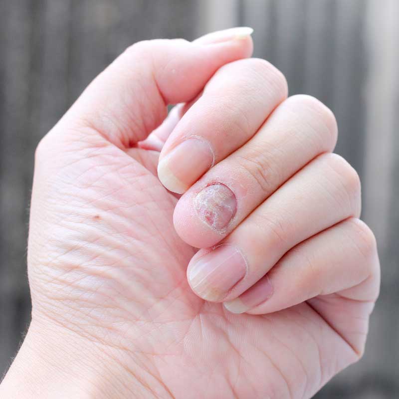 gljivice na noktima simptomi