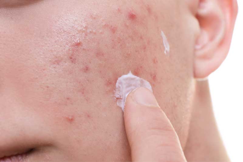 acne vulgaris krema