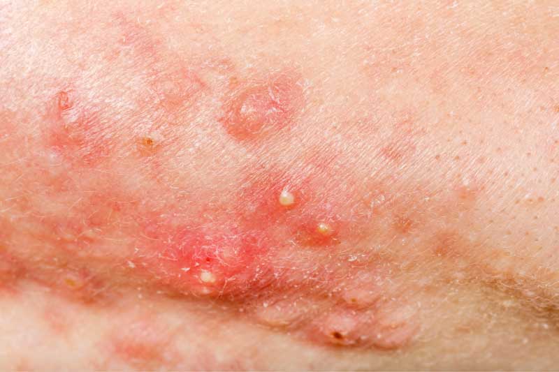 acne conglobata simptomi