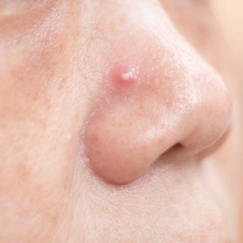 bubuljica na nosu