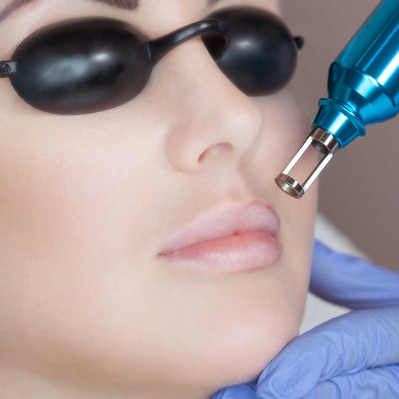 povećanje usana laserom