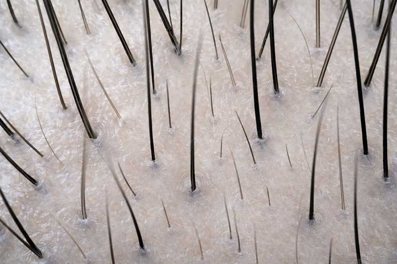 androgena alopecija simptomi