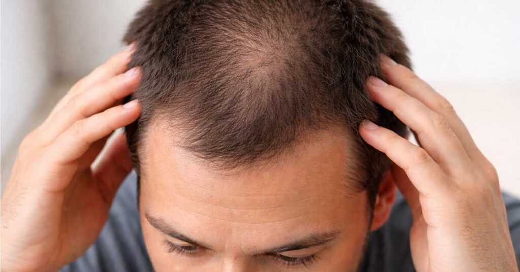androgena alopecija