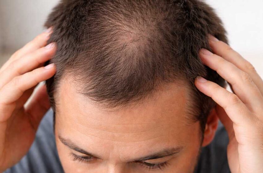  Androgena alopecija: uočite prve simptome na vreme